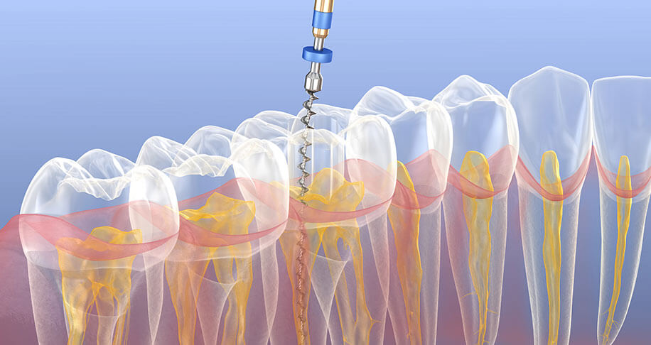What is a Root Canal Treatment